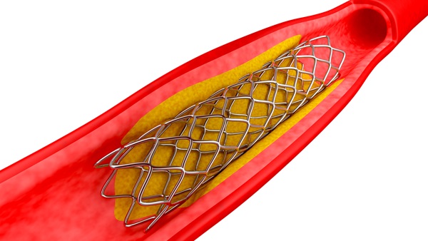 Angina, Angioplasty, Bypass, CAD, Heart Attack, Stent