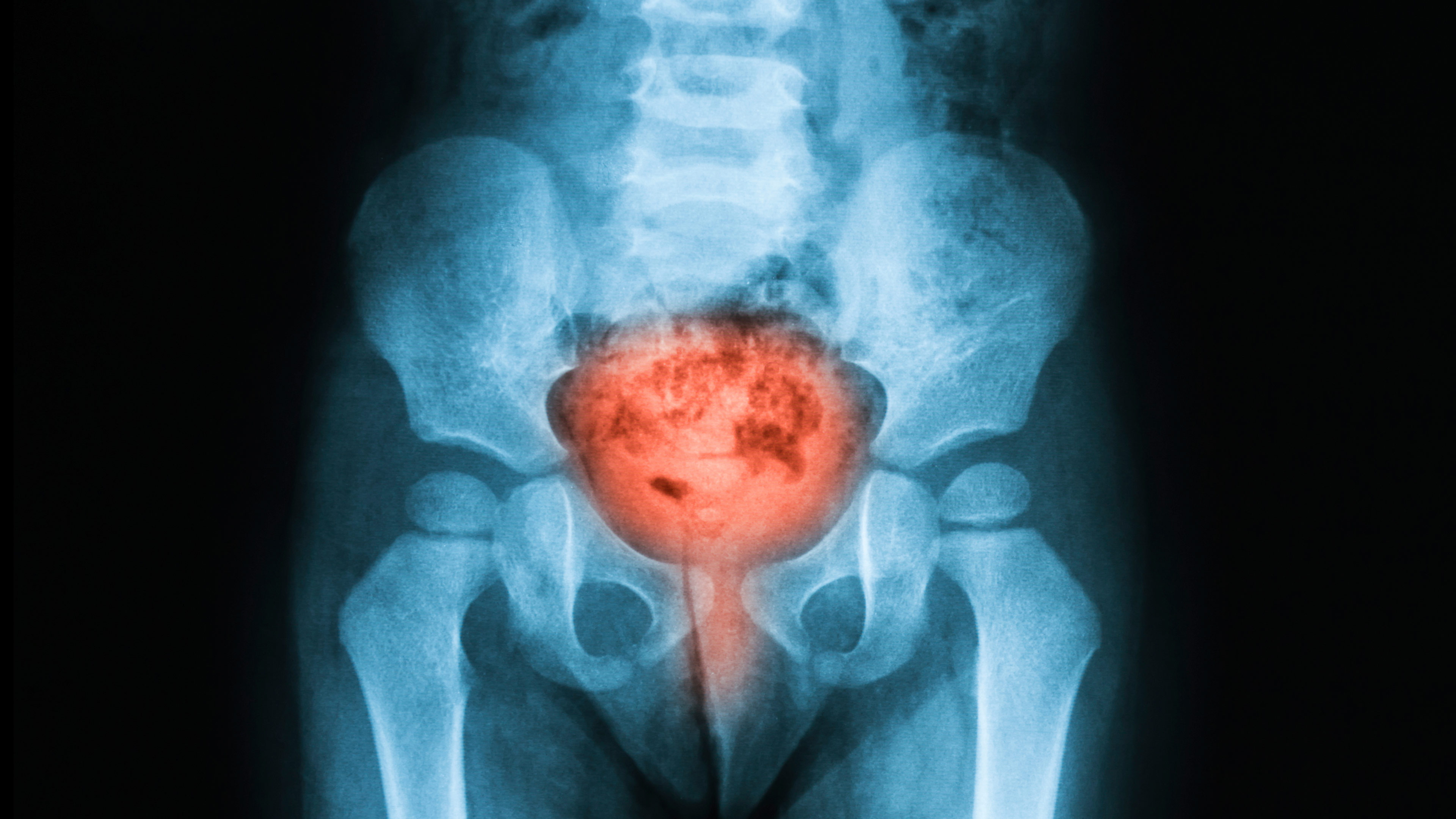 Bladder Cancer - AOPA